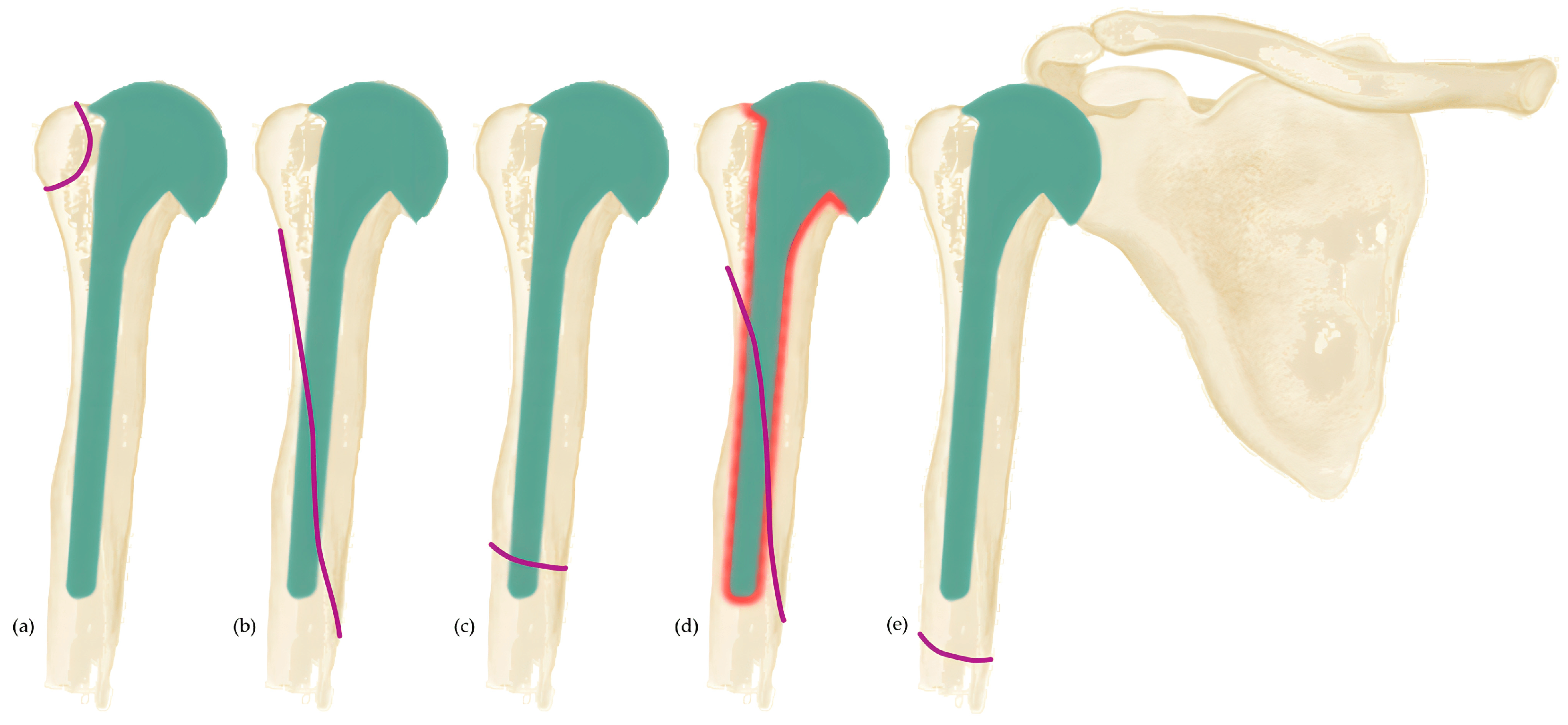 Periprosthetic Glenoid Fractures