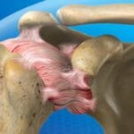 What is Frozen Shoulder and How Can It Be Managed?