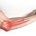 How to Recognize and Treat Golfer’s Elbow