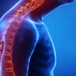 Kyphosis (Roundback) of the Spine