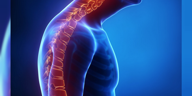 Kyphosis (Roundback) of the Spine