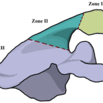 Acromial and Scapular Spine Stress Fractures