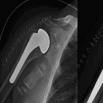 Proximal Humerus Fractures