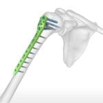 Humeral Shaft Fractures