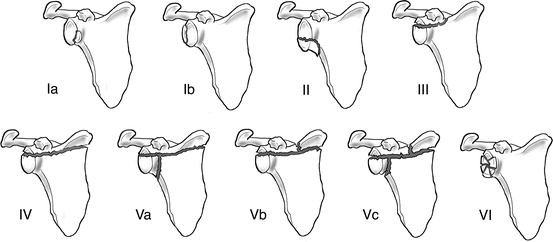 Scapula Body and Glenoid Fossa Fractures