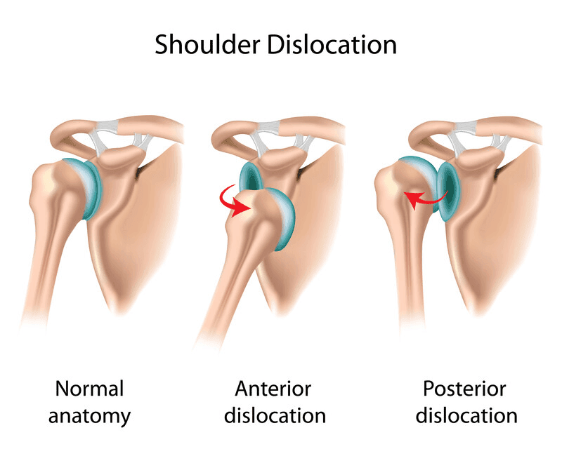 Understanding Chronic Shoulder Instability