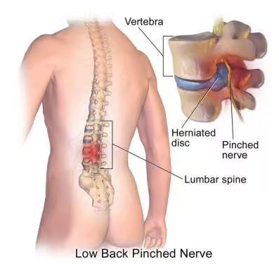 Comprehensive Treatment Options for Low Back Pain