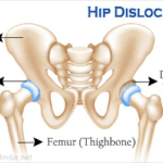 Hip Dislocation: A Serious Injury Requiring Immediate Attention