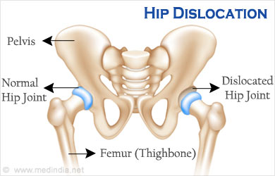 Hip Dislocation: A Serious Injury Requiring Immediate Attention
