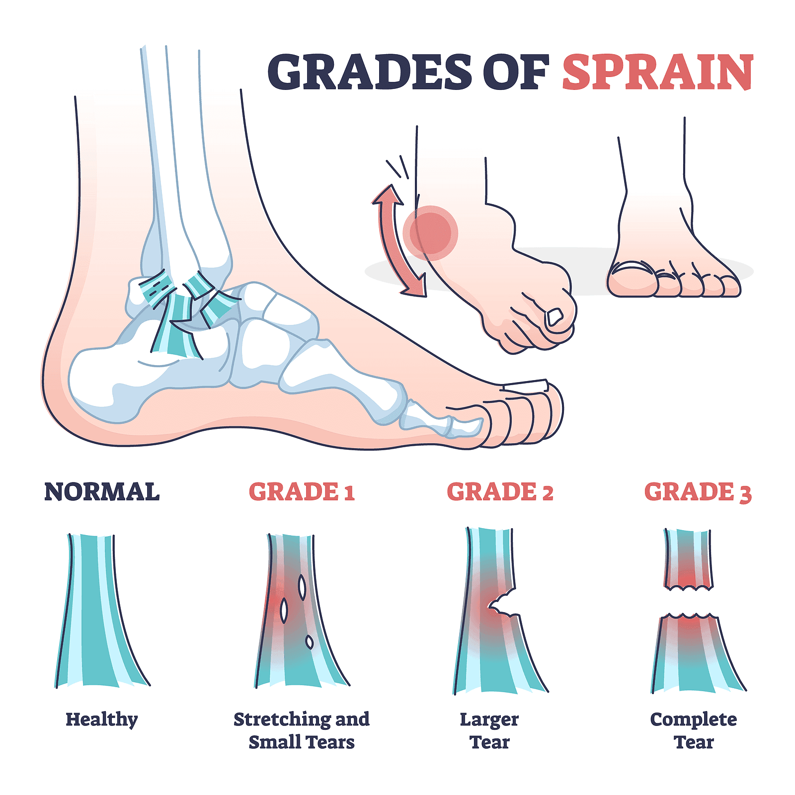 Ankle Sprains: What’s Normal and What’s Not?