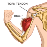 Why Does My Arm Look Like Popeye’s?