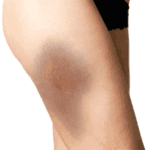 Managing Muscle Contusions: An Athlete’s Guide