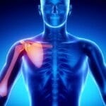 Clavicle Fracture: Understanding Collarbone Breaks