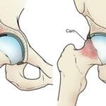 Understanding Hip Arthroscopy: A Guide to Minimally Invasive Hip Surgery