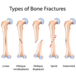 Comprehensive Guide to Understanding and Managing Different Types of Arm Fractures