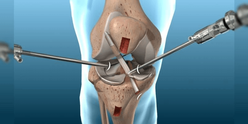 Knee Arthroscopy: An Overview