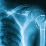How to Identify and Treat Stress Fractures in the Arm