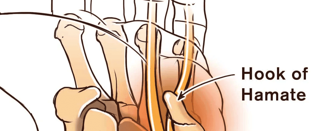 Ortho Globe Hook Of Hamate Fractures