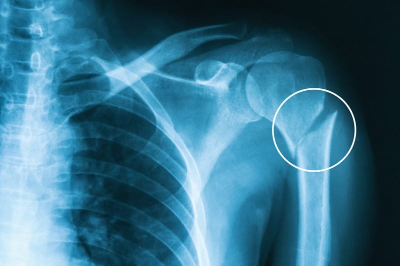 Ortho Globe | How to Identify and Treat Stress Fractures in the Arm