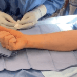 Complications following surgery