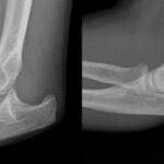 Simple Elbow Dislocation
