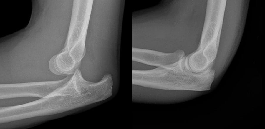 Simple Elbow Dislocation