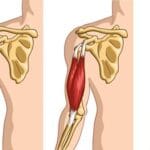 How to Recognize and Treat Arm Muscle Strains