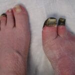 Understanding Frostbite: Symptoms, Risks, and Prevention Tips