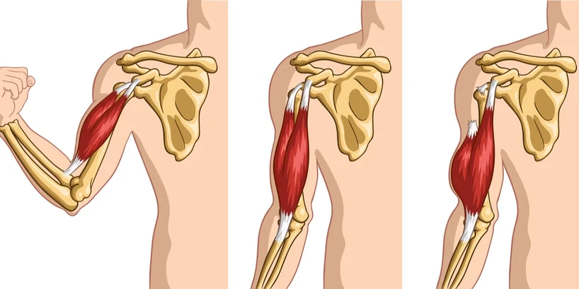 How do I know if the pain is caused by a biceps tendon injury?