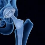 How do I protect myself from artificial joint infection?