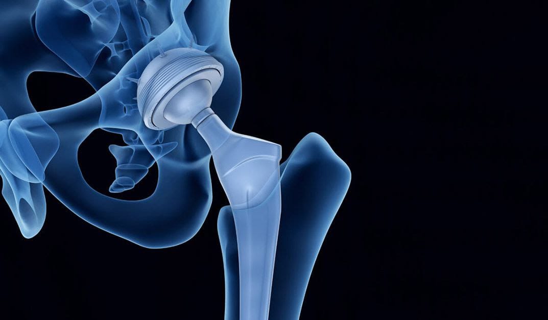 How do I protect myself from artificial joint infection?