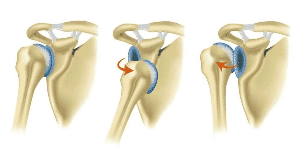 Difference Between Shoulder Dislocation and Subluxation