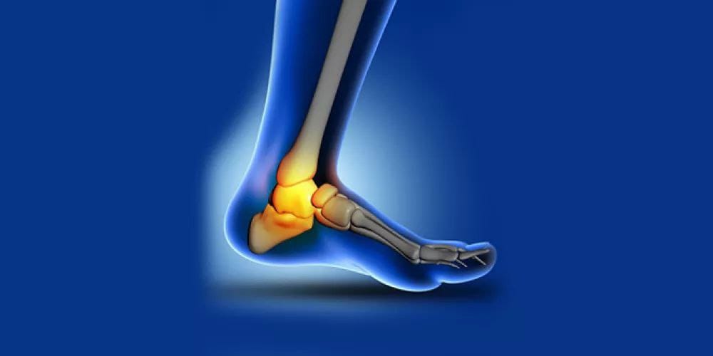 Ankle arthritis and its treatment