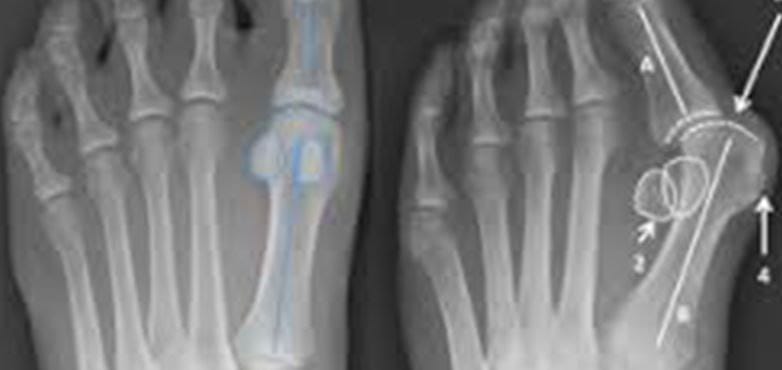 Surgery to treat tumors in the toe