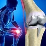 Is minimally invasive knee replacement surgery right for you?