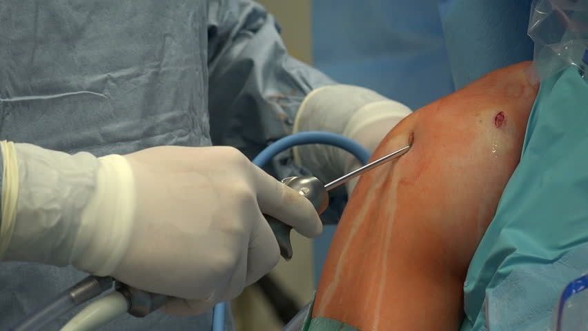 Is surgery necessary for rotator cuff injury?