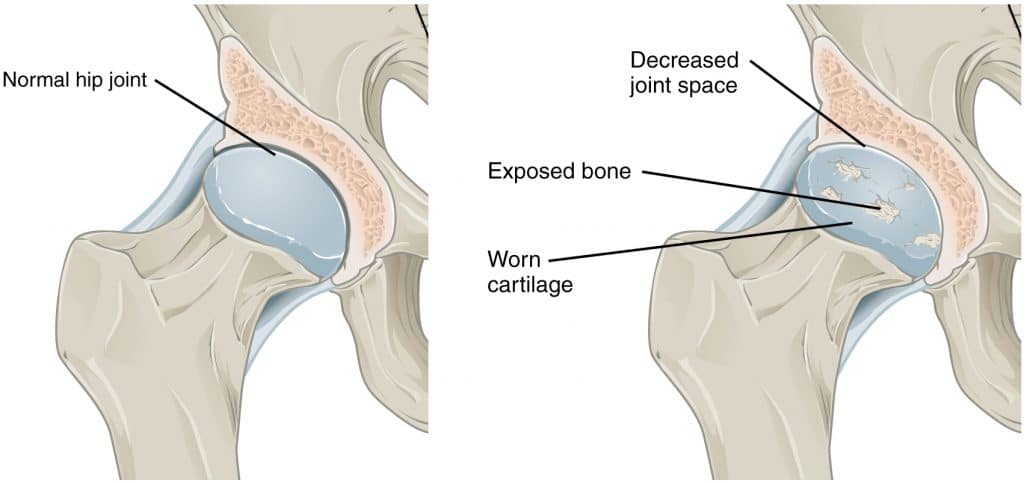 Synovial Chondromatosis: Causes, Symptoms, Diagnosis, and Treatment