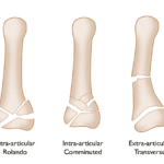 Understanding Thumb Fractures: Risks, Recovery, and Long-Term Impacts