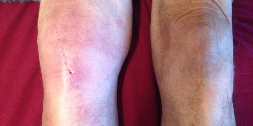 Understanding Joint Replacement Infections: Prevention, Symptoms, and Treatment
