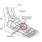 Understanding and Managing Stress Fractures in the Foot and Ankle