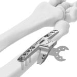 Ulnar Shortening Surgery