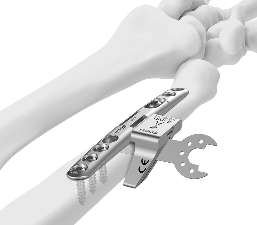 Ulnar Shortening Surgery