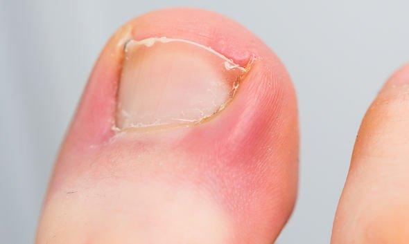 Understanding and Preventing Ingrown Toenails: Causes and Solutions