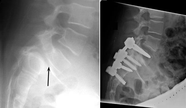 Spondylolysis and Spondylolisthesis