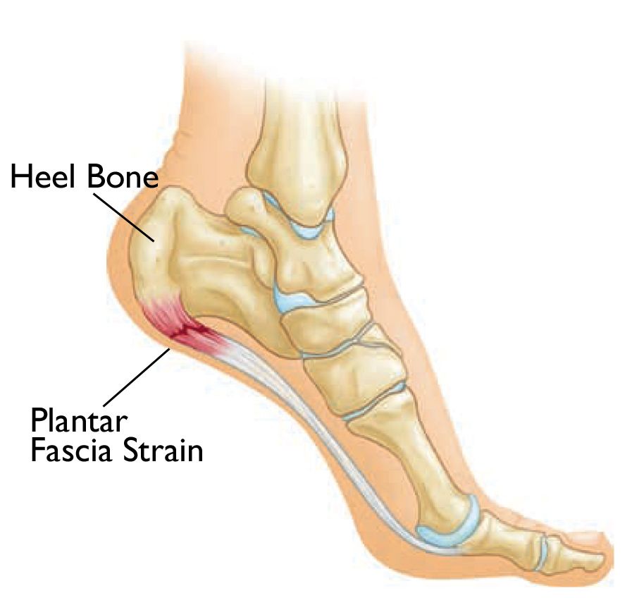 Understanding Heel Pain: Causes and Treatment of Plantar Fasciitis and Bone Spurs