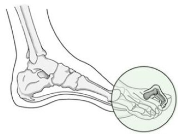 Understanding Claw Toe: Causes, Symptoms, and Treatment Options