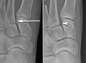 Understanding Lisfranc Injuries: Causes, Symptoms, and Treatment Options