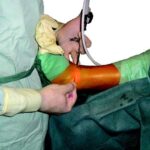 Managing Arthritis in the Foot and Ankle: Causes, Symptoms, and Treatment Options