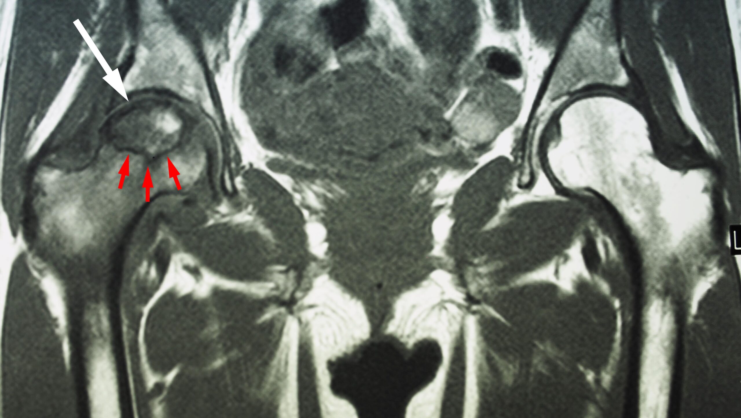 Understanding Avascular Necrosis: Causes, Effects, and Treatment Options
