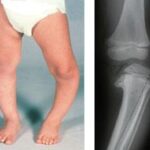 Understanding Bowed Legs in Children and Adolescents: Causes and When to Seek Help